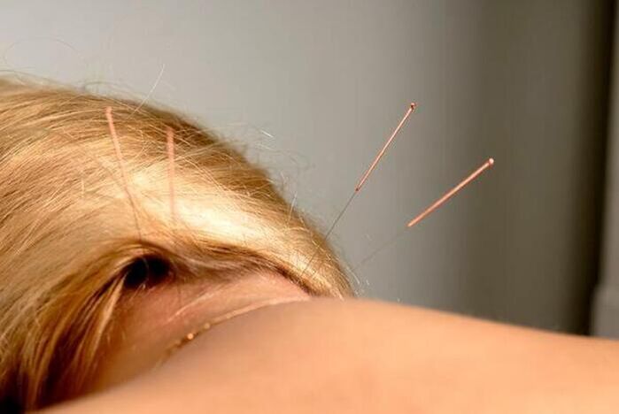 acupuntura para la osteocondrosis