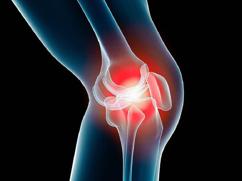 artrosis de rodilla
